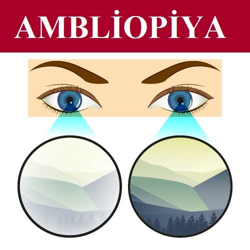 Ambliopiya (tənbəl göz) nədir?