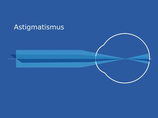 Astiqmatizm necə yaranır və risk faktorları hansılardır?